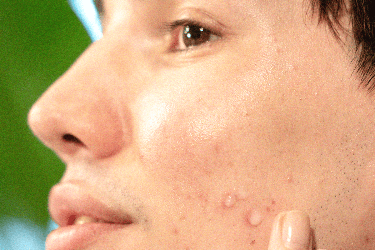 the best ingredients for acne prone skin