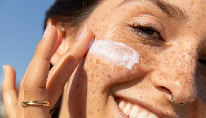 what is a sunburn?